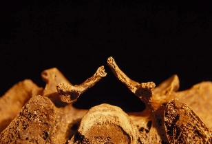 Photograph showing unfused neural arch on the posterior surface of the 1st sacral segment (indicative of spina bifida occulta)