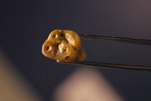 View of molar tooth with exposed pulp cavities