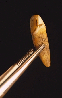 Evidence of antemortem dental plaque