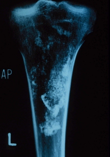 X-ray of proximal portion of a tibia with infiltration of sand and reef debris