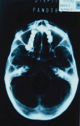 X-Ray of the inferior region of Harry's skull