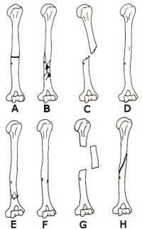 Figure 2: Types of long bone fracture (Mann and Murphy
1990 fig. 97)